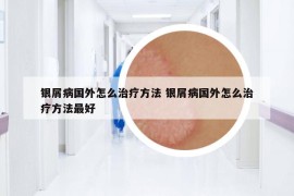 銀屑病國(guó)外怎么治療方法 銀屑病國(guó)外怎么治療方法最好
