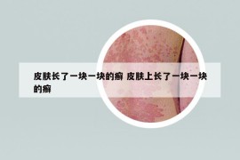 皮膚長了一塊一塊的癬 皮膚上長了一塊一塊的癬