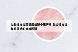 溢脂性皮炎跟銀屑病那個更嚴重 脂溢性皮炎和銀屑病的癥狀區(qū)別