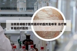治銀屑病哪個醫(yī)院最好的醫(yī)院是哪家 治療銀屑最好的醫(yī)院