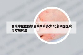 北京中醫(yī)醫(yī)院銀屑病大約多少 北京中醫(yī)醫(yī)院治療銀屑病