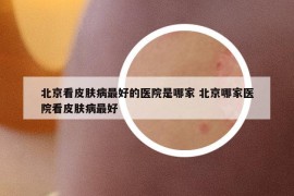 北京看皮膚病最好的醫(yī)院是哪家 北京哪家醫(yī)院看皮膚病最好