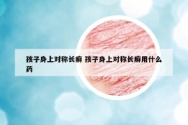 孩子身上對(duì)稱長(zhǎng)癬 孩子身上對(duì)稱長(zhǎng)癬用什么藥