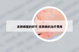 皮膚癬醫(yī)的好不 皮膚癬的治療費用