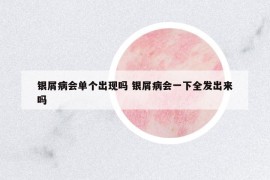 銀屑病會單個出現(xiàn)嗎 銀屑病會一下全發(fā)出來嗎