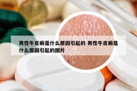 男性牛皮癬是什么原因引起的 男性牛皮癬是什么原因引起的圖片