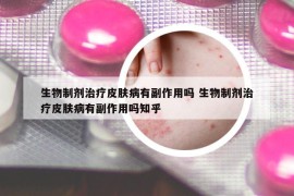 生物制劑治療皮膚病有副作用嗎 生物制劑治療皮膚病有副作用嗎知乎
