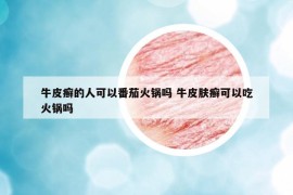 牛皮癬的人可以番茄火鍋嗎 牛皮膚癬可以吃火鍋嗎