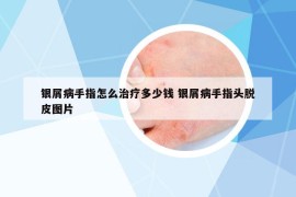 銀屑病手指怎么治療多少錢 銀屑病手指頭脫皮圖片
