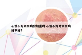 心情不好銀屑病會加重嗎 心情不好對銀屑病好不好?