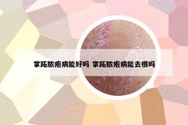 掌跖膿皰病能好嗎 掌跖膿皰病能去根嗎