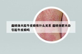 扁桃體大能牛皮癬有什么關(guān)系 扁桃體肥大會引起牛皮癬嗎