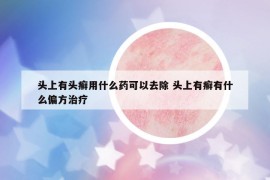 頭上有頭癬用什么藥可以去除 頭上有癬有什么偏方治療