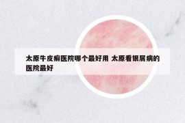 太原牛皮癬醫(yī)院哪個最好用 太原看銀屑病的醫(yī)院最好