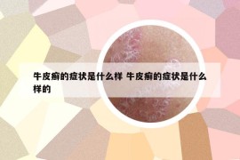 牛皮癬的癥狀是什么樣 牛皮癬的癥狀是什么樣的