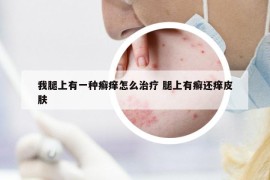 我腿上有一種癬癢怎么治療 腿上有癬還癢皮膚