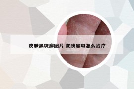 皮膚黑斑癬圖片 皮膚黑斑怎么治療