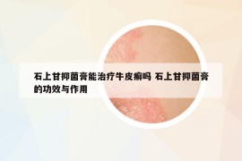 石上甘抑菌膏能治療牛皮癬嗎 石上甘抑菌膏的功效與作用