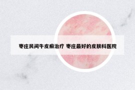 棗莊民間牛皮癬治療 棗莊最好的皮膚科醫(yī)院