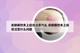 皮膚癬飲食上應該注意什么 皮膚癬飲食上應該注意什么問題