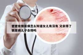 爸爸有銀屑病怎么知道女兒有沒有 父親得了銀屑病兒子會得嗎