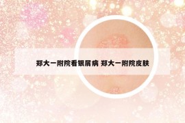 鄭大一附院看銀屑病 鄭大一附院皮膚