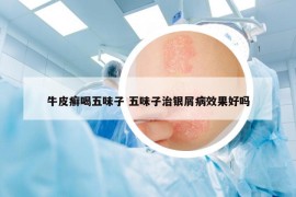 牛皮癬喝五味子 五味子治銀屑病效果好嗎