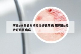 阿維a吃多長時間能治好銀屑病 服阿維a能治好銀屑病嗎