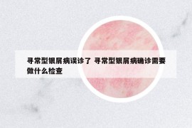 尋常型銀屑病誤診了 尋常型銀屑病確診需要做什么檢查