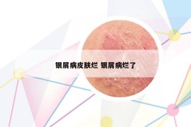 銀屑病皮膚爛 銀屑病爛了