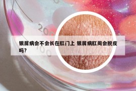 銀屑病會不會長在肛門上 銀屑病肛周會脫皮嗎?