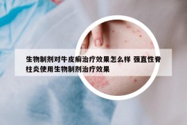 生物制劑對(duì)牛皮癬治療效果怎么樣 強(qiáng)直性脊柱炎使用生物制劑治療效果