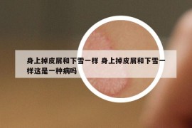 身上掉皮屑和下雪一樣 身上掉皮屑和下雪一樣這是一種病嗎