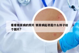 看看銀屑病的照片 銀屑病起初是什么樣子給個(gè)圖片?