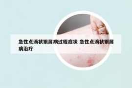 急性點滴狀銀屑病過程癥狀 急性點滴狀銀屑病治療