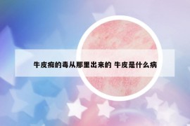 牛皮癡的毒從那里出來的 牛皮是什么病