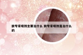 膚專家噴劑主要治什么 膚專家噴劑是治什么的