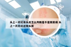 頭上一片紅有頭皮怎么判斷是不是銀屑病 頭上一片片紅還有頭屑