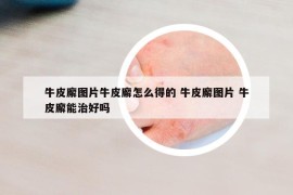 牛皮廨圖片牛皮廨怎么得的 牛皮廨圖片 牛皮廨能治好嗎
