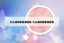 什么病和銀屑病相似 什么病和銀屑病很像