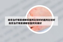南京治療銀屑病哪家醫(yī)院比較好的醫(yī)院比較好 南京治療銀屑病哪家醫(yī)院效果好