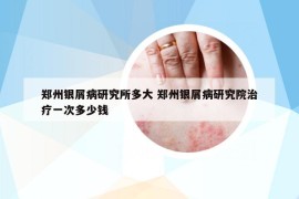 鄭州銀屑病研究所多大 鄭州銀屑病研究院治療一次多少錢