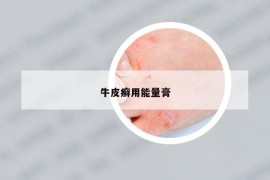 牛皮癬用能量膏