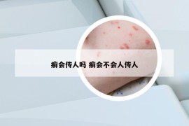 癬會傳人嗎 癬會不會人傳人