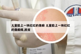 兒童臉上一塊紅紅的像癬 兒童臉上一塊紅紅的像癬癢,脫皮