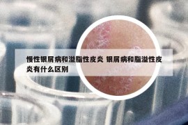 慢性銀屑病和溢脂性皮炎 銀屑病和脂溢性皮炎有什么區(qū)別