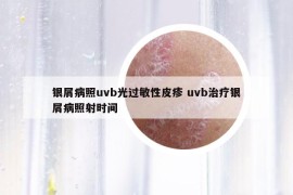 銀屑病照uvb光過(guò)敏性皮疹 uvb治療銀屑病照射時(shí)間
