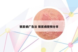 銀屑病廣告法 銀屑病視頻分享