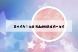 黃水瘡與牛皮癬 黃水瘡和黃皮瘡一樣嗎