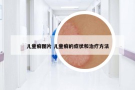 兒童癬圖片 兒童癬的癥狀和治療方法